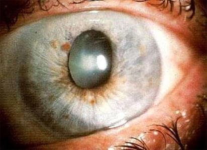 Glaucoma: 12–14m Nigerians at risk of vision loss — FG