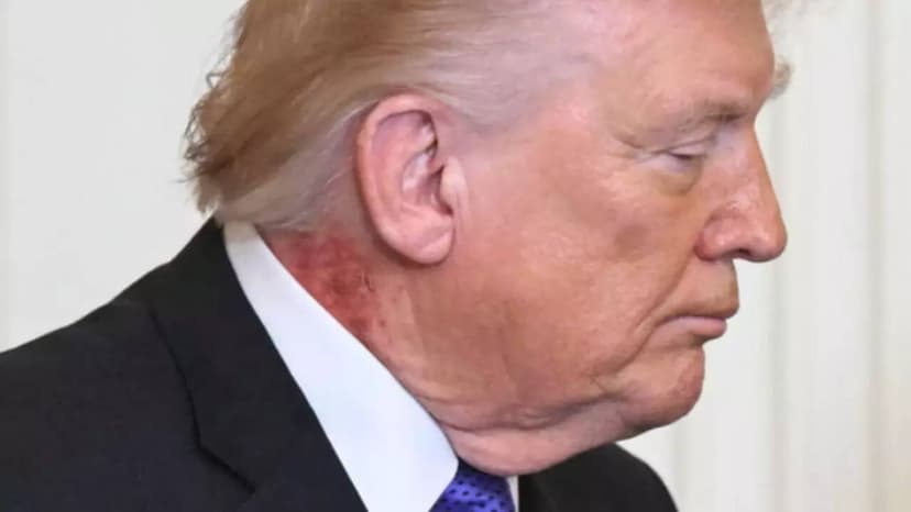 Donald Trump Appears with Red Rash on Neck, Doctor Explains
