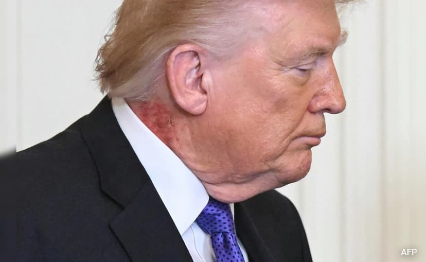 Speculation Over Trump's Health After Red Spot on Neck