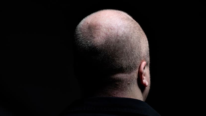 Baldness | Doctor explains modern methods for treating hair loss