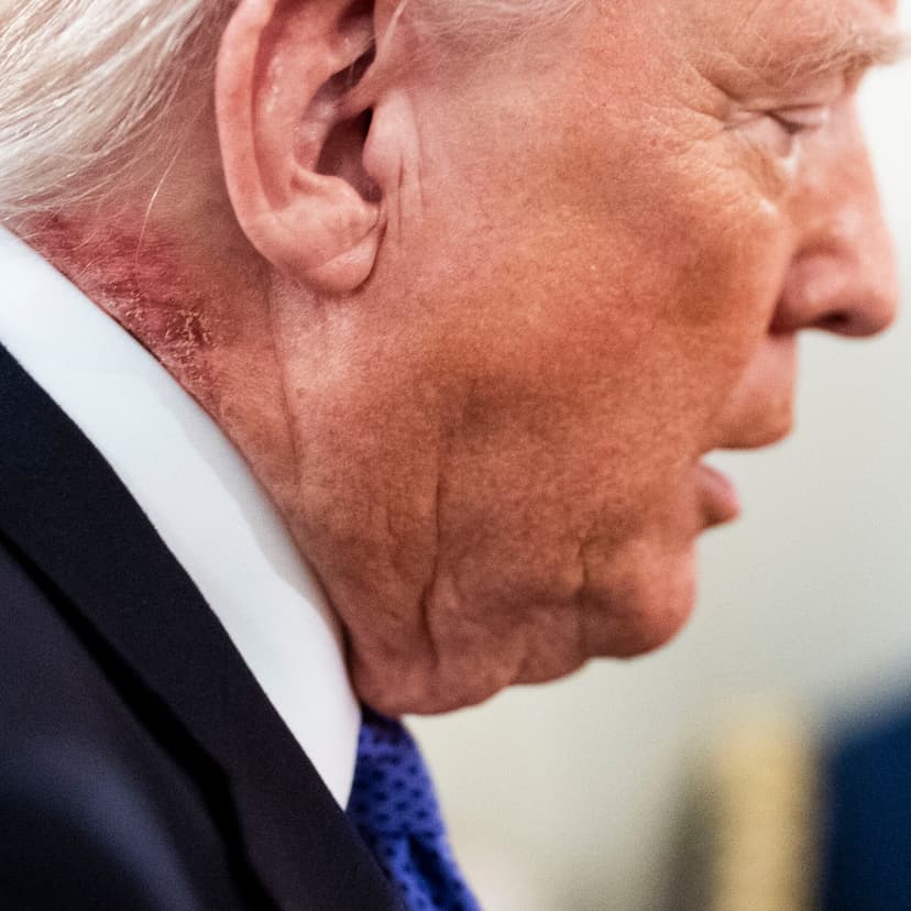 President Trump Appears at Public Event With a Red Skin Rash