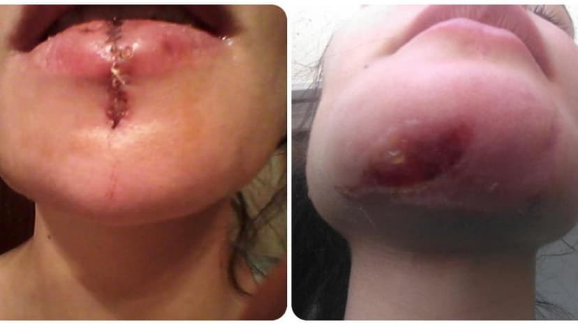 The surgeon sued by actress Blanca Espino: "She asked me for another burn on her face"