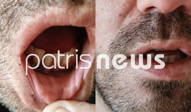 Inmate Severely Beaten in Police Custody in Ilia, Greece