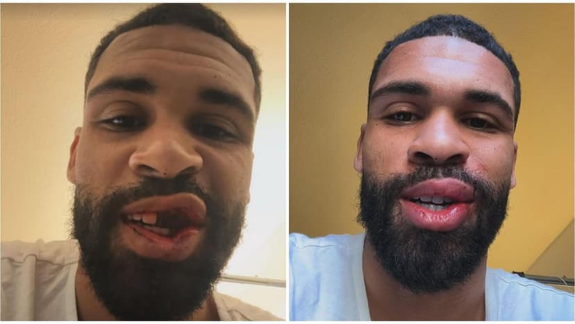 Ruben Loftus-Cheek Undergoes Dental Surgery